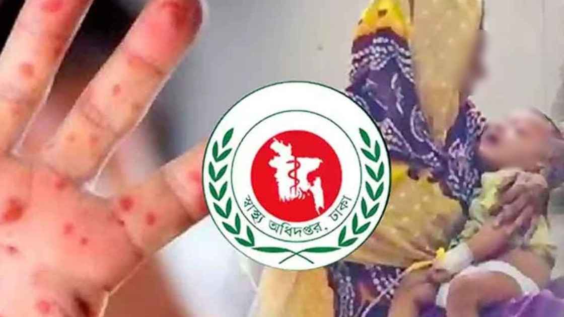 হাম উপসর্গে আরও ৩ শিশুর মৃত্যু