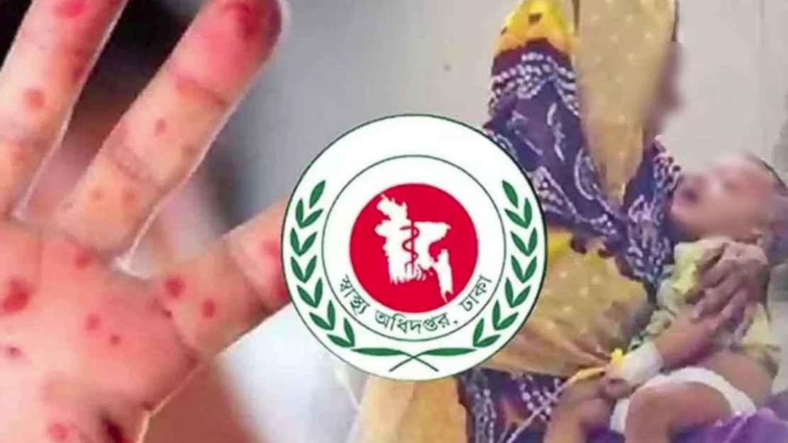 হাম উপসর্গে আরও ৪ শিশুর মৃত্যু